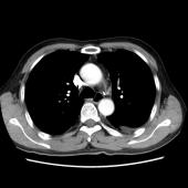 【病例】肺肉瘤样癌1例CT影像表现