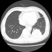 【病例】肺肉瘤样癌1例CT影像表现