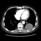 【病例】肺肉瘤样癌1例CT影像表现