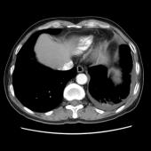 【病例】肺肉瘤样癌1例CT影像表现
