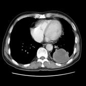 【病例】肺肉瘤样癌1例CT影像表现