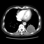 【病例】肺肉瘤样癌1例CT影像表现