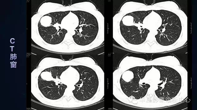 【病例】肺肉瘤样癌1例CT影像表现