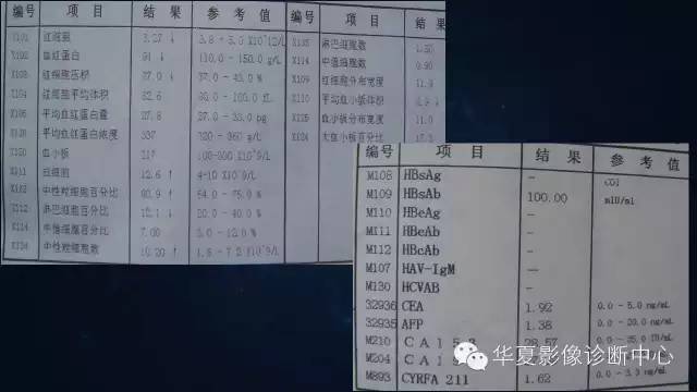【病例】肺肉瘤样癌1例CT影像表现