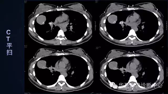 【病例】肺肉瘤样癌1例CT影像表现