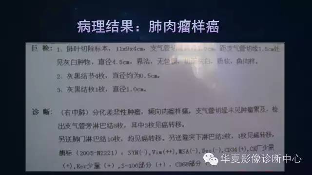 【病例】肺肉瘤样癌1例CT影像表现