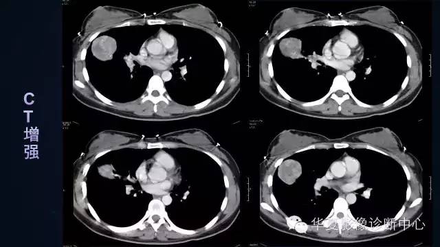 【病例】肺肉瘤样癌1例CT影像表现