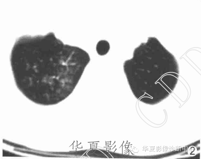 【病例】支原体肺炎1例CT影像表现