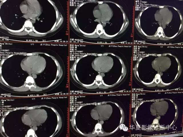【病例】支原体肺炎1例CT影像表现