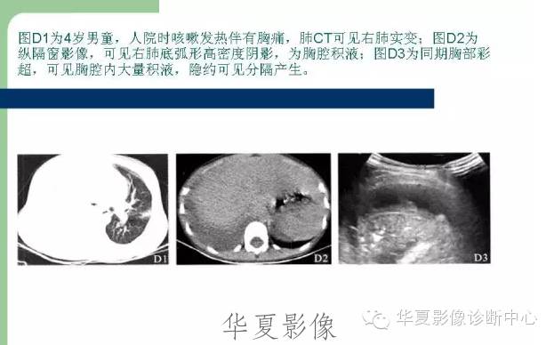 【病例】支原体肺炎1例CT影像表现