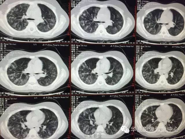 【病例】支原体肺炎1例CT影像表现