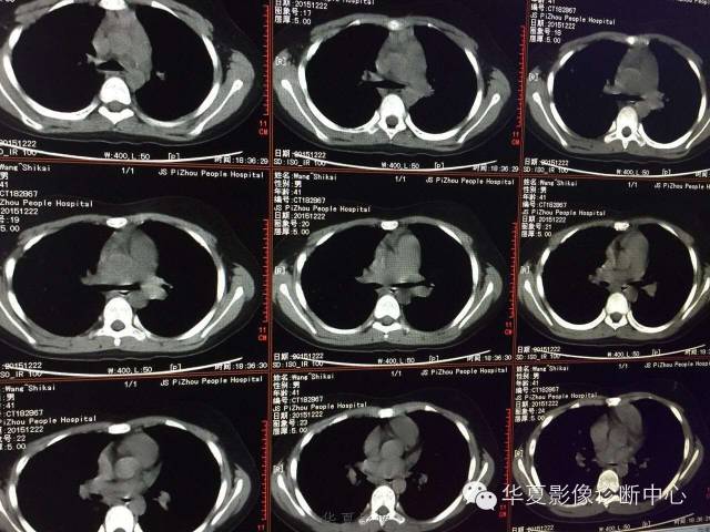 【病例】支原体肺炎1例CT影像表现