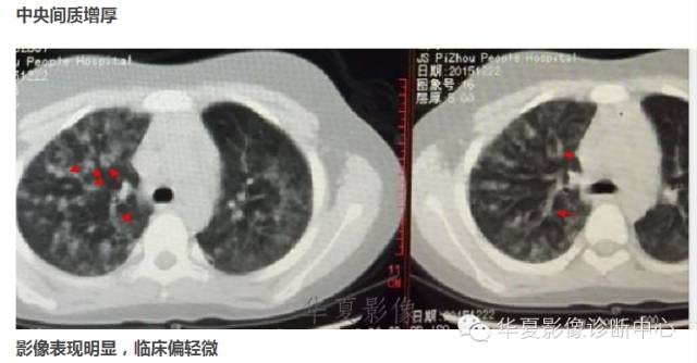 【病例】支原体肺炎1例CT影像表现