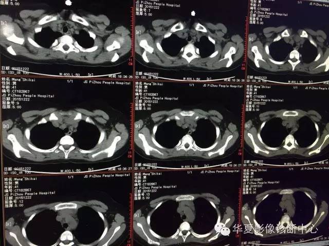 【病例】支原体肺炎1例CT影像表现