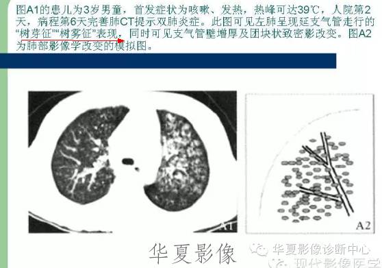 【病例】支原体肺炎1例CT影像表现