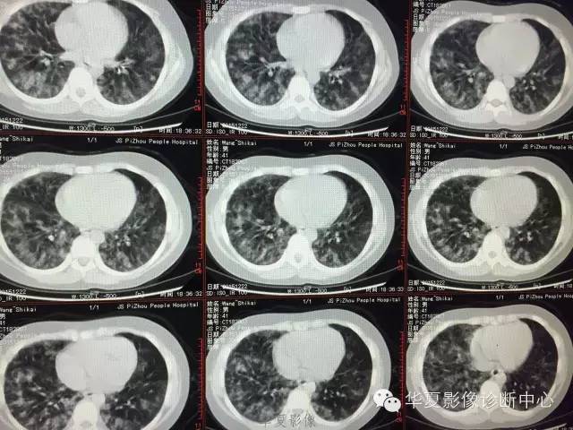 【病例】支原体肺炎1例CT影像表现