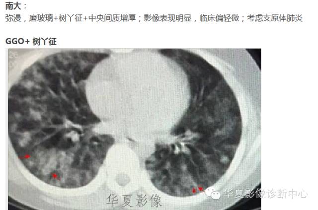 【病例】支原体肺炎1例CT影像表现
