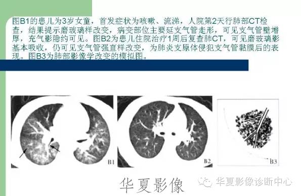【病例】支原体肺炎1例CT影像表现