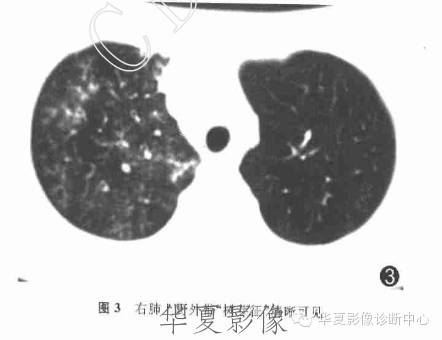 【病例】支原体肺炎1例CT影像表现