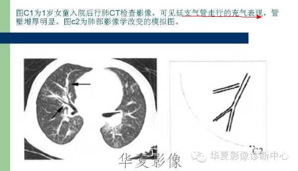 【病例】支原体肺炎1例CT影像表现