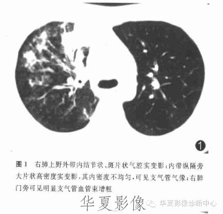 【病例】支原体肺炎1例CT影像表现