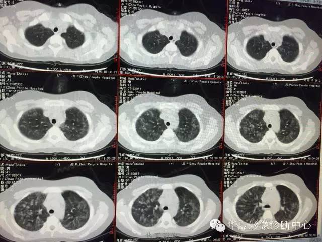 【病例】支原体肺炎1例CT影像表现