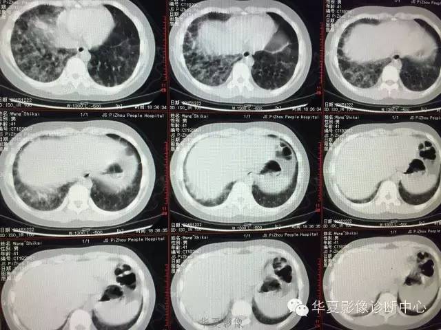 【病例】支原体肺炎1例CT影像表现