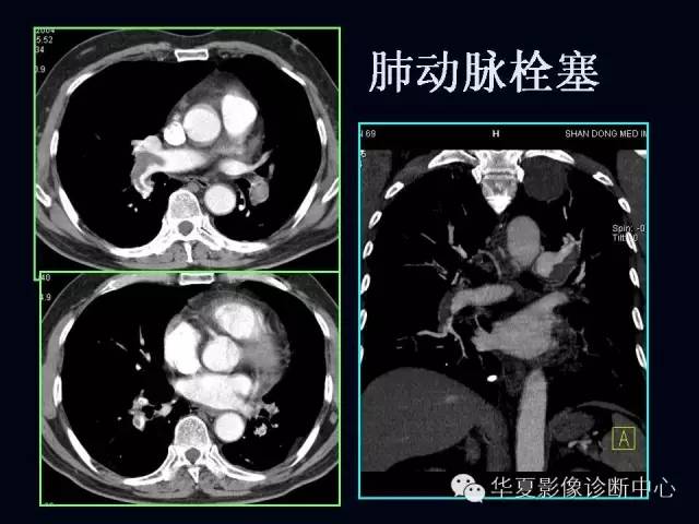 【PPT】肺部血管性疾病