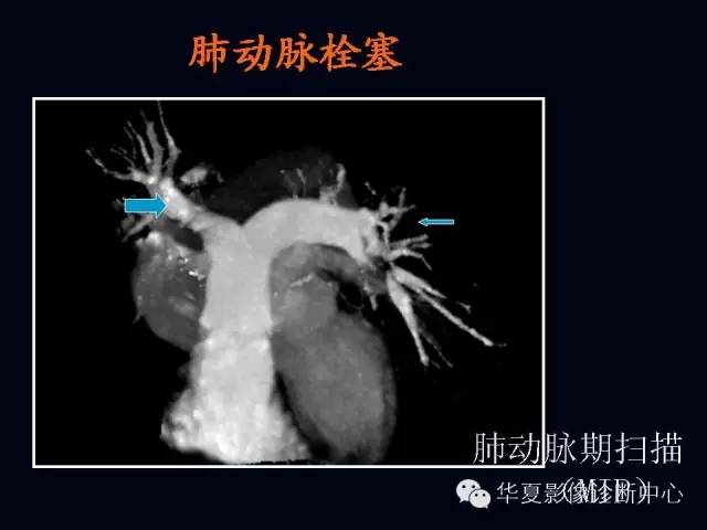 【PPT】肺部血管性疾病