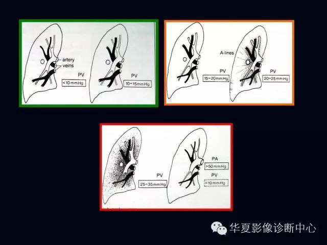 【PPT】肺部血管性疾病