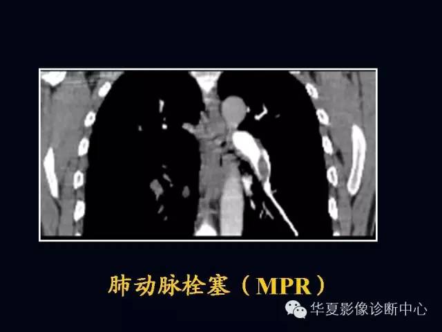 【PPT】肺部血管性疾病