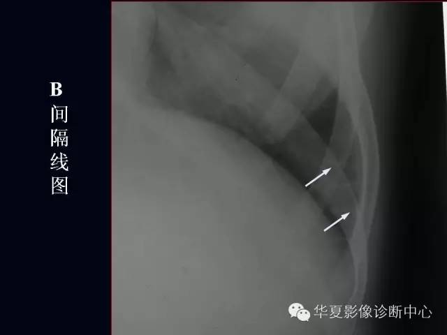 【PPT】肺部血管性疾病