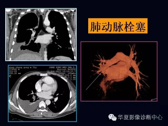 【PPT】肺部血管性疾病