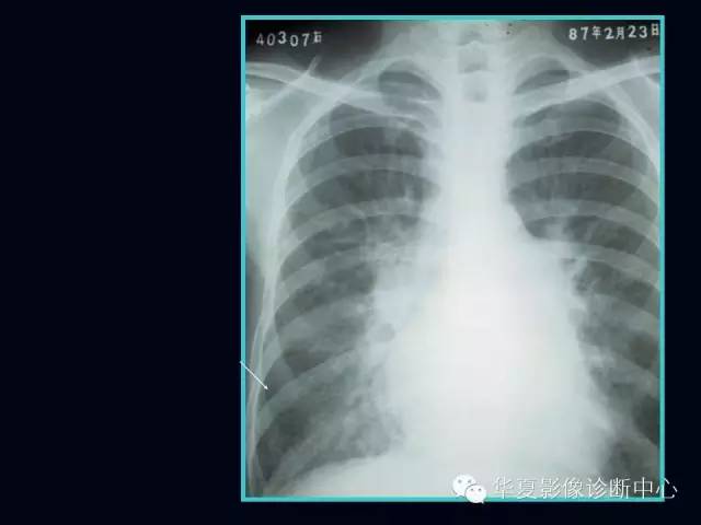 【PPT】肺部血管性疾病