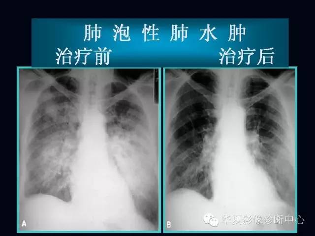 【PPT】肺部血管性疾病