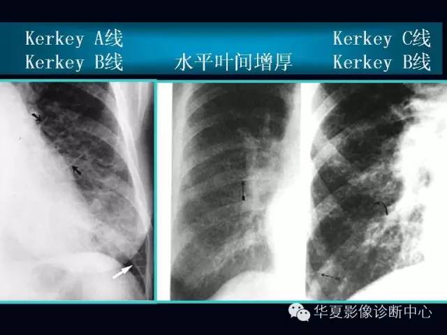 【PPT】肺部血管性疾病