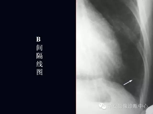 【PPT】肺部血管性疾病