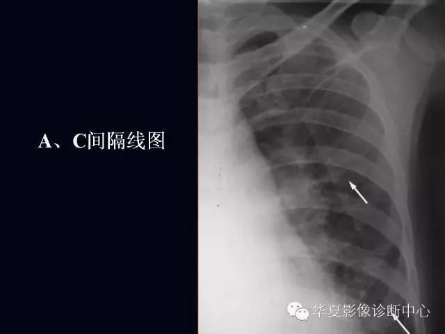 【PPT】肺部血管性疾病