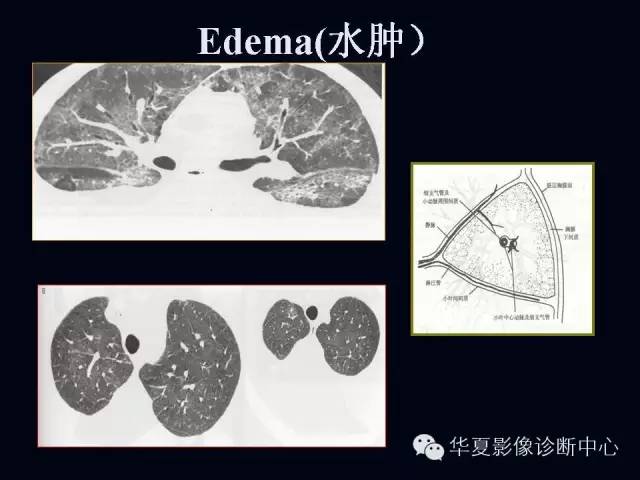 【PPT】肺部血管性疾病