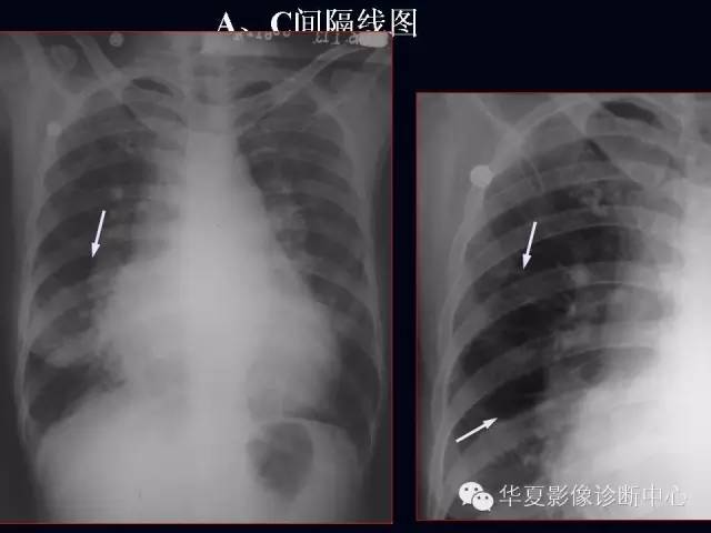 【PPT】肺部血管性疾病