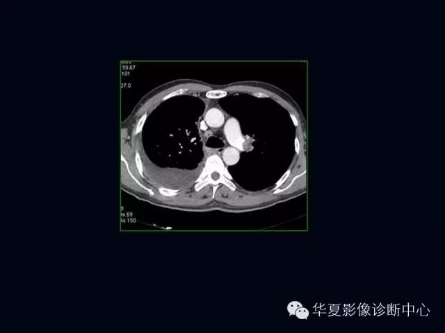 【PPT】肺部血管性疾病