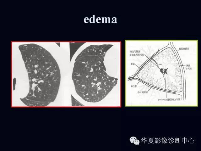 【PPT】肺部血管性疾病