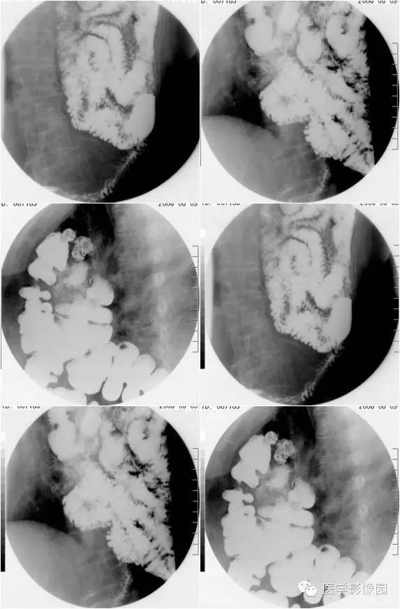 【病例】膈疝1例影像表现