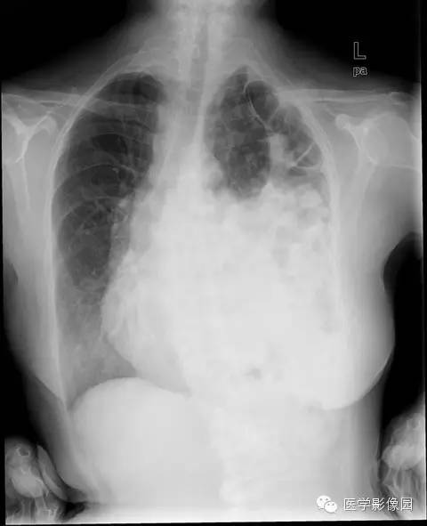 【病例】膈疝1例影像表现