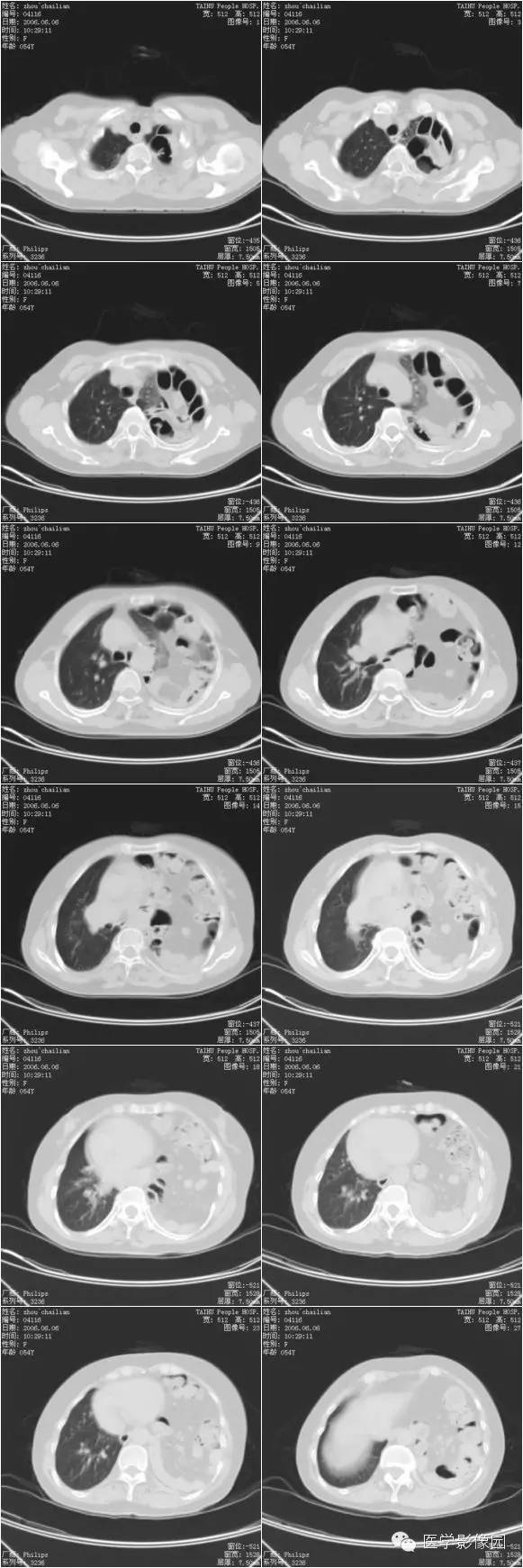 【病例】膈疝1例影像表现