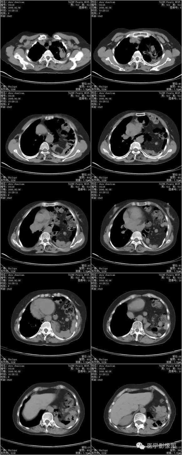 【病例】膈疝1例影像表现