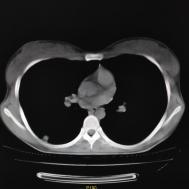 【病例】支原体肺炎1例CT影像表现