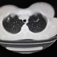 【病例】支原体肺炎1例CT影像表现