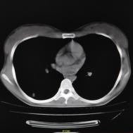 【病例】支原体肺炎1例CT影像表现