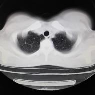 【病例】支原体肺炎1例CT影像表现